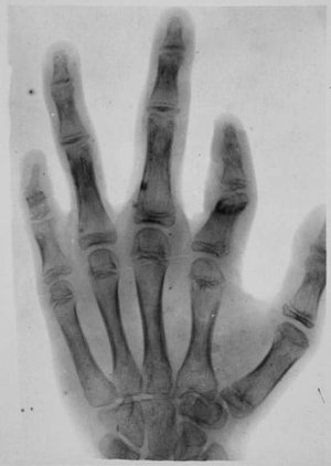 Radiografia d'una mà afectada per una malformació