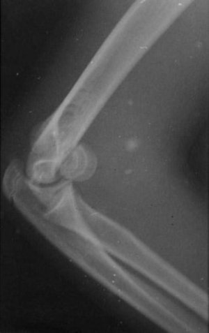 Radiografia d'un colze afectat per una malformació