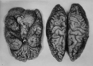 Disecció d'un tumor cerebral