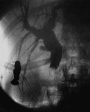 Radiografia d'un aneurisme a la cavitat toràcica